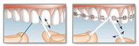 Miradent Mirafloss Implant - zubní nit pro implantáty - obrázek 3